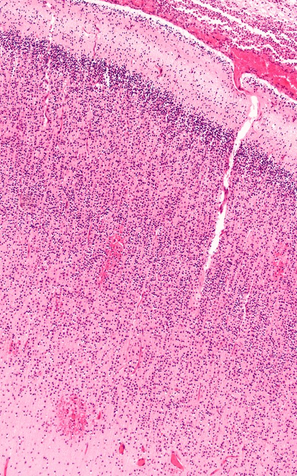 12B1 Meningitis, E Coli (Case 12) N4 H&E 1