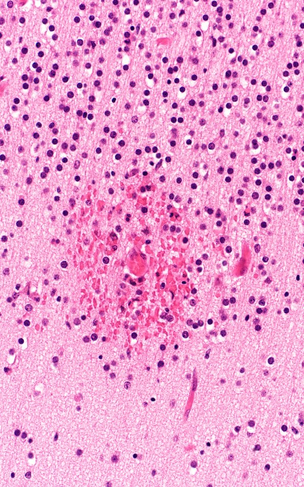 12B2 Meningitis, E Coli (Case 12) N4 H&E 40X