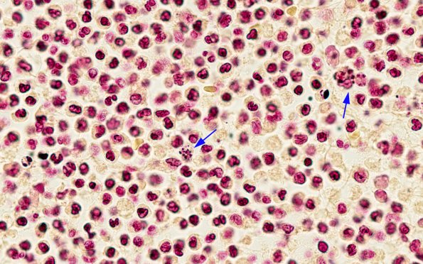 12C Meningitis, E Coli (Case 12) N13 Gram 100X 1 copy