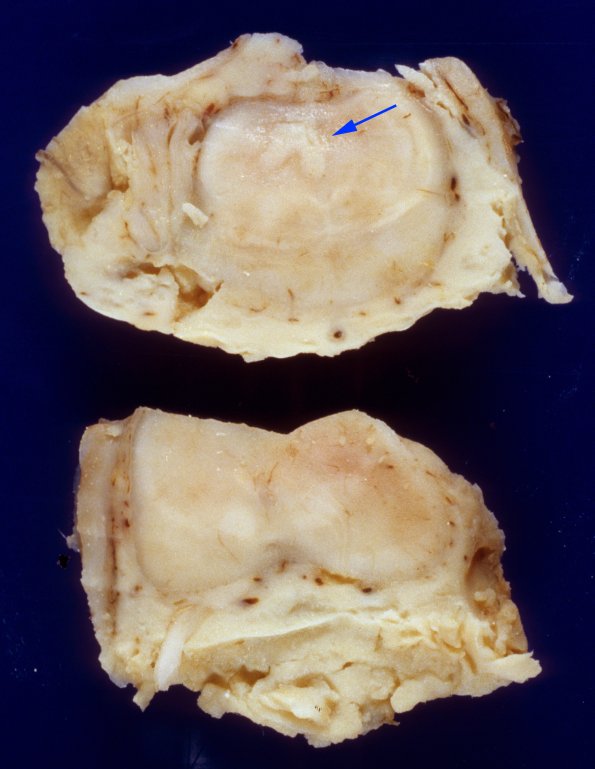 13A2 Meningitis, bacterial (Case 13) EColi 2 (acqueductal occlusion) copy