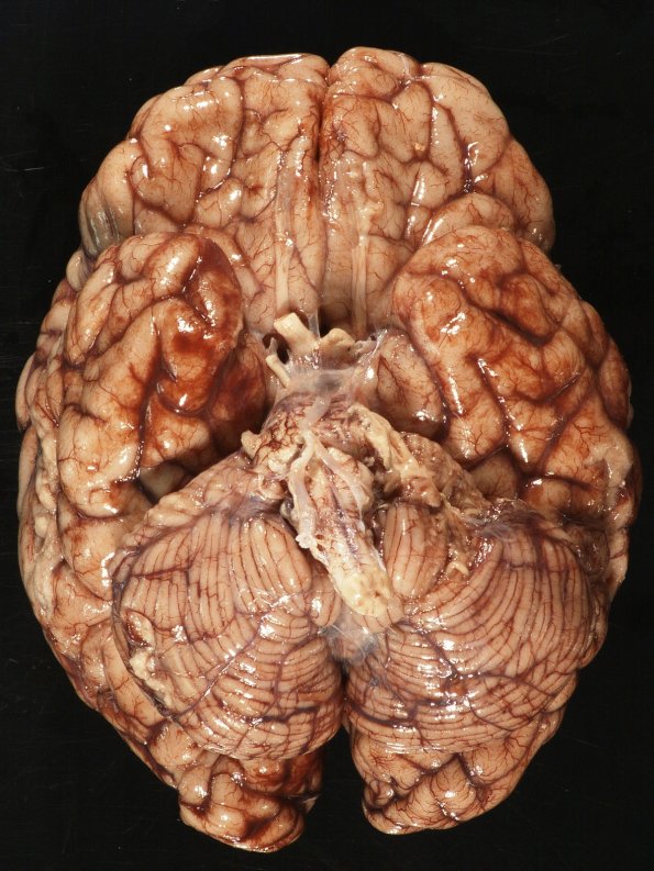 14A1 Meningitis, Neisseria meningitidis (Case 14) 1