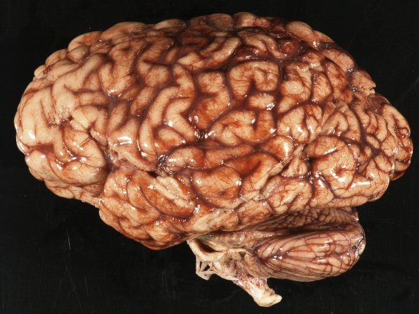 14A2 Meningitis, Neisseria meningitidis (Case 14) 2