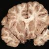 14A3 Meningitis, Neisseria meningitidis (Case 14) 3