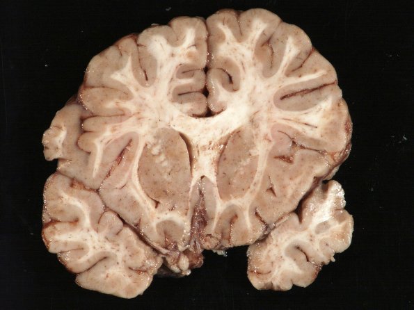 14A3 Meningitis, Neisseria meningitidis (Case 14) 3