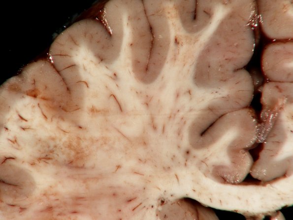 14A4 Meningitis, Neisseria meningitidis (Case 14) 6