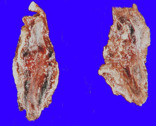 14C1 Meningitis, Neisseria meningitidis (Case 14) Waterhouse-Friderichsen 2