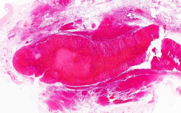 14C3 Meningitis, Neisseria meningitidis (Case 14) H&E 2 Adrenal