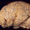 15A1 Meningoencephalitis, bacterial, thrombophlebitis (Case 15) 1