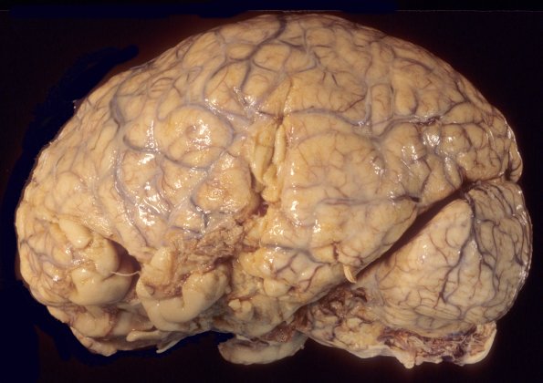 15A1 Meningoencephalitis, bacterial, thrombophlebitis (Case 15) 1