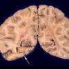 15A2 Meningoencephalitis, bacterial, thrombophlebitis (Case 15) 3 copy