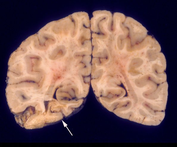 15A2 Meningoencephalitis, bacterial, thrombophlebitis (Case 15) 3 copy