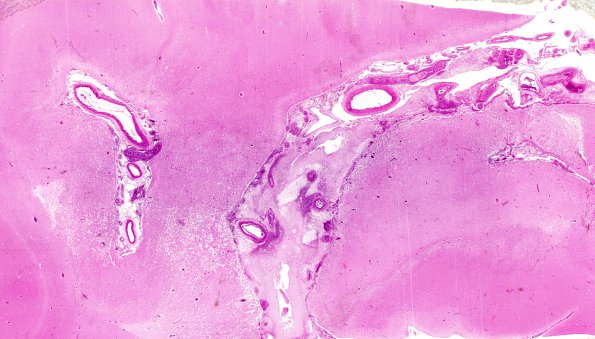 16A1 Meningitis & arteritis (Case 16) H&E whole mount 2