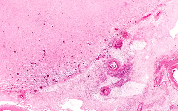 16A2 Meningitis & arteritis (Case 16) H&E 2X 1