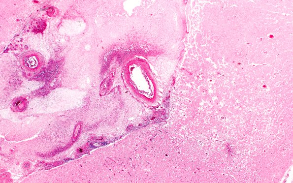 16A3 Meningitis & arteritis (Case 16) H&E 2X 2