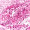 16A4 Meningitis & arteritis (Case 16) H&E 20X