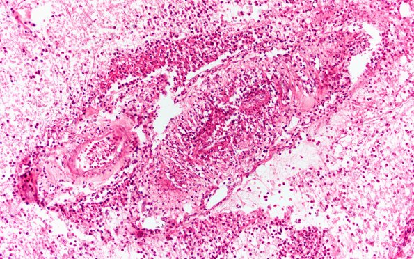 16A4 Meningitis & arteritis (Case 16) H&E 20X