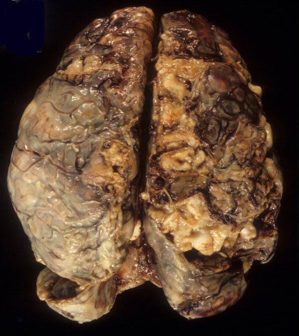 17A1 Meningoencephalitis, PC (Case 17) 3