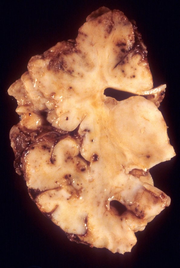 17A2 Meningoencephalitis, PC (Case 17) 1