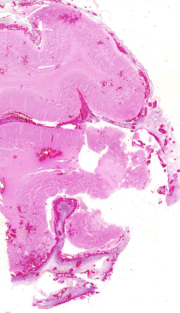 17B Meningoencephalitis, PC (Case 17) 5