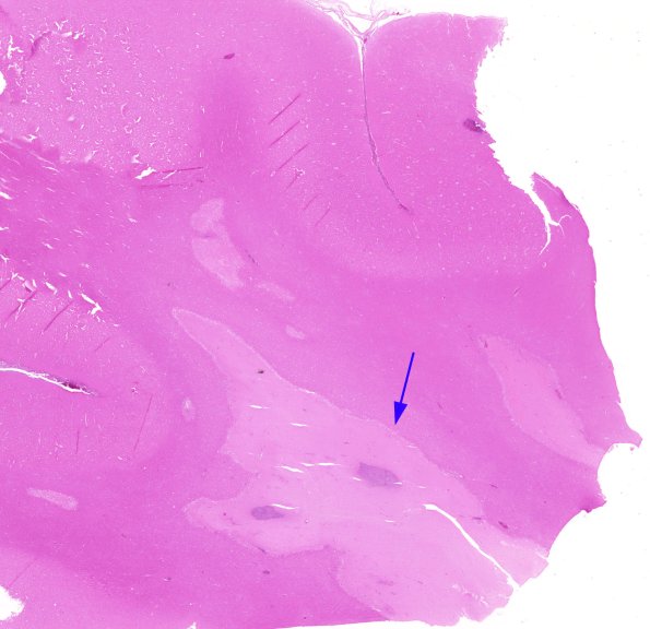 18B1 Meningitis, PC with secondary infarction (Case 18) N1 H&E 1 copy A