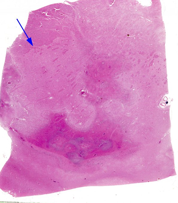 18B2 Meningitis, PC with secondary infarction (Case 18) N2 copy