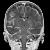 1A1 Meningitis, infarcts (Case 1) T1 W 1