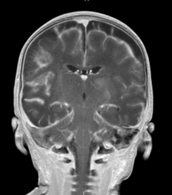 1A1 Meningitis, infarcts (Case 1) T1 W 1