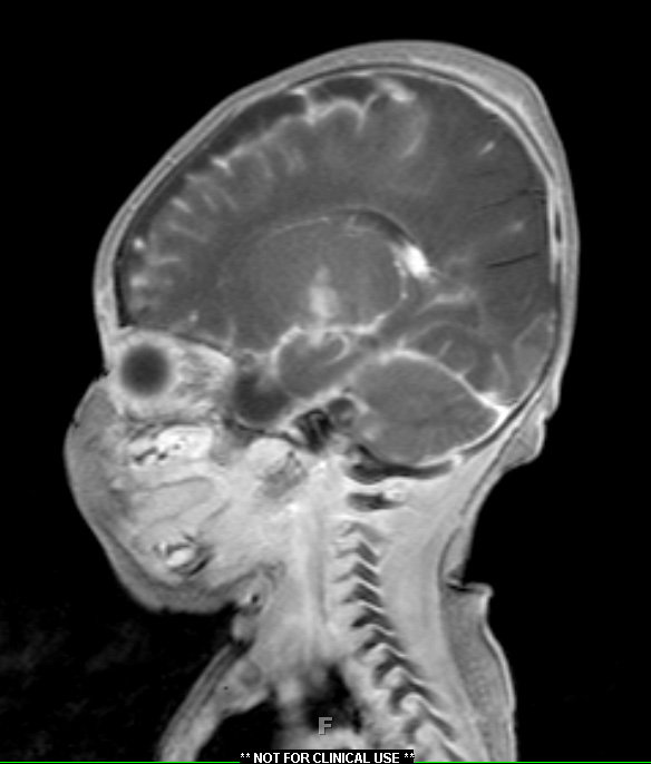 1A2 Meningitis, infarcts (Case 1) T1 W 4