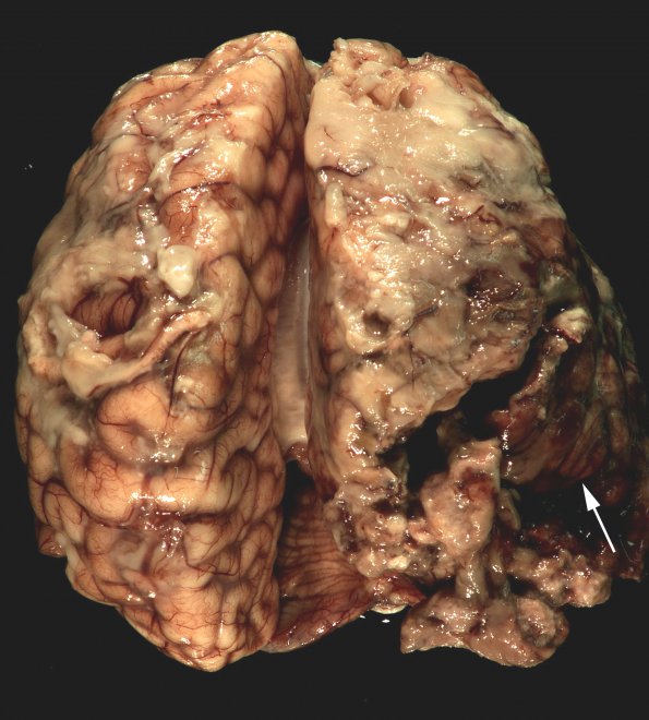 1C1 Meningitis, Group B STR, Infarcts, Vasculitis (Case 1) _5 copy