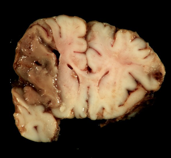 1C2 Meningitis, Group B STR, Infarcts, Vasculitis (Case 1) _9