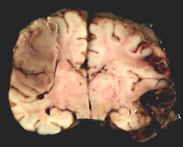 1C3 Meningitis, Group B STR, Infarcts, Vasculitis (Case 1) _11