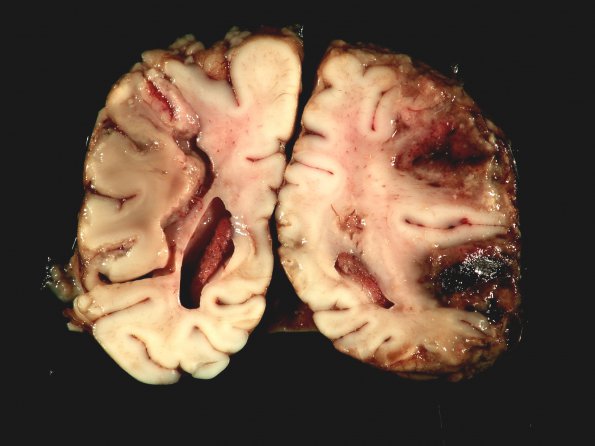 1C4 Meningitis, Group B STR, Infarcts, Vasculitis (Case 1) _12