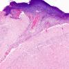 1D1 Meningitis, Group B STR (Case 1) N11 H&E A3 A