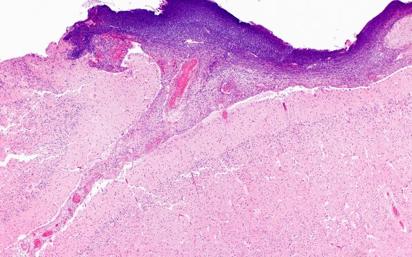 1D1 Meningitis, Group B STR (Case 1) N11 H&E A3 A