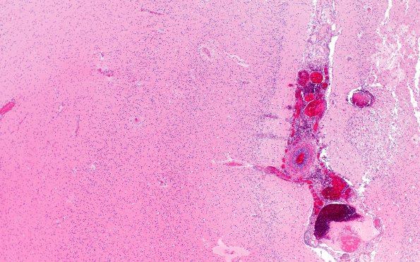 1D2 Meningitis, Group B STR (Case 1) N11 H&E A1