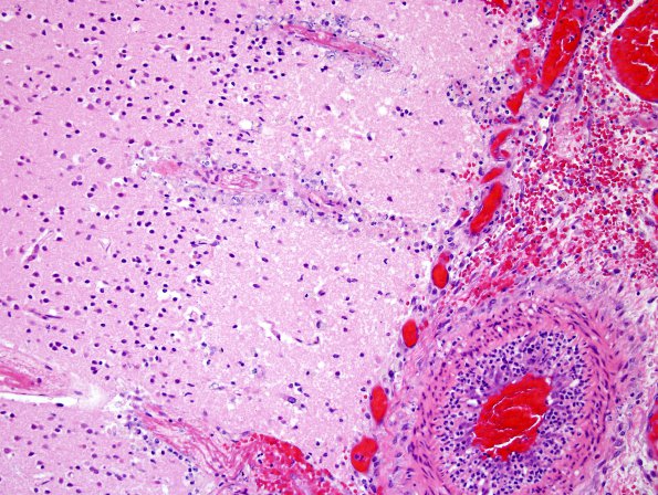 1D3 Meningitis, Group B STR (Case 1) N11 H&E 2