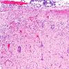 1D5 Meningitis, Group B STR (Case 1) N12 H&E A4