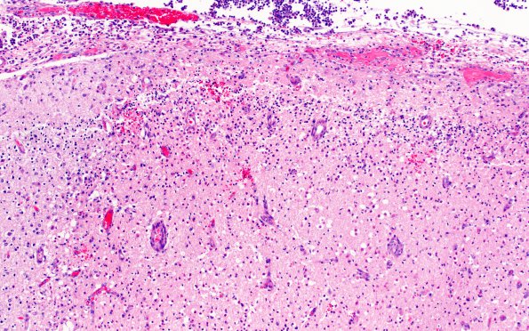 1D5 Meningitis, Group B STR (Case 1) N12 H&E A4