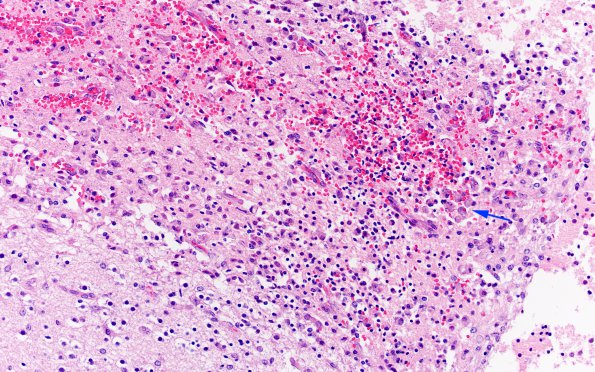 1D7 Meningitis, Group B STR (Case 1) N12 H&E A1 copy