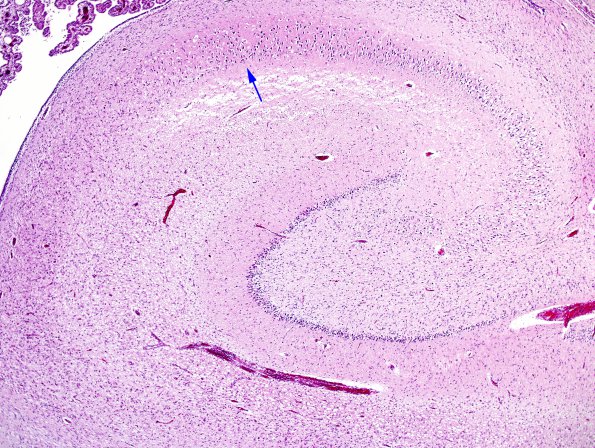 1E1 Meningitis, Group B STR (Case 1) N3 1 copy