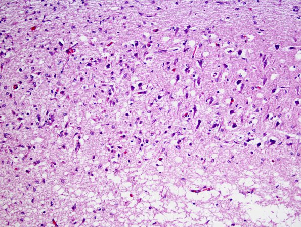 1E2 Meningitis, Group B STR (Case 1) N3 CA1