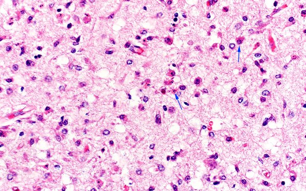 1E3 Meningitis, Group B STR (Case 1) N3 subiculum H&E A1 copy