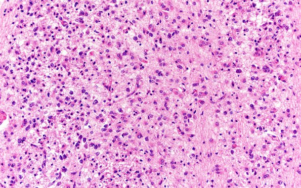 1F Meningitis, Group B STR (Case 1) N7 ponto-subicular H&E A1