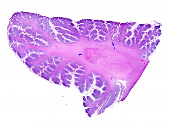 1G1 Meningitis, Group B STR (Case 1) N9 H&E whole mount copy