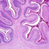 1G2 Meningitis, Group B STR (Case 1) N9 H&E 3