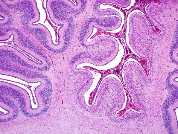 1G2 Meningitis, Group B STR (Case 1) N9 H&E 3