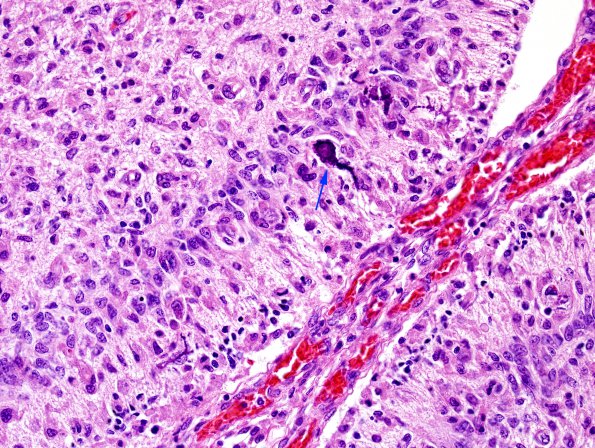 1G3 Meningitis, Group B STR (Case 1) N9 H&E 1 copy