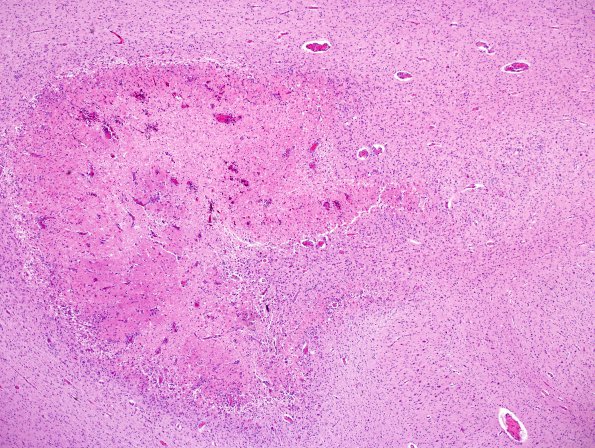 1H1 Meningitis, Group B STR (Case 1) N9 H&E 7