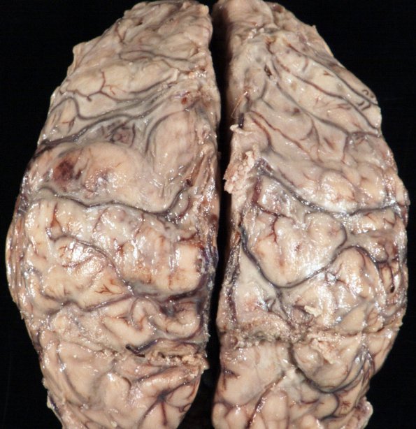 2A1 Meningitis, Strep pneu (Case 2) 2