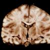 2A3 Meningitis, Strep pneu (Case 2) 17